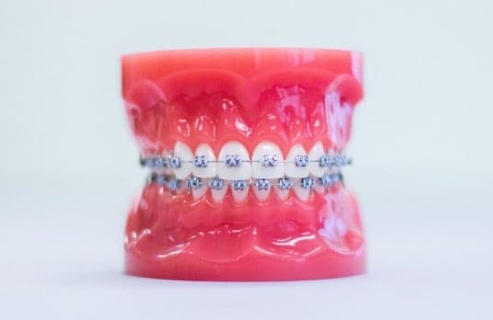 metal braces on plastic model